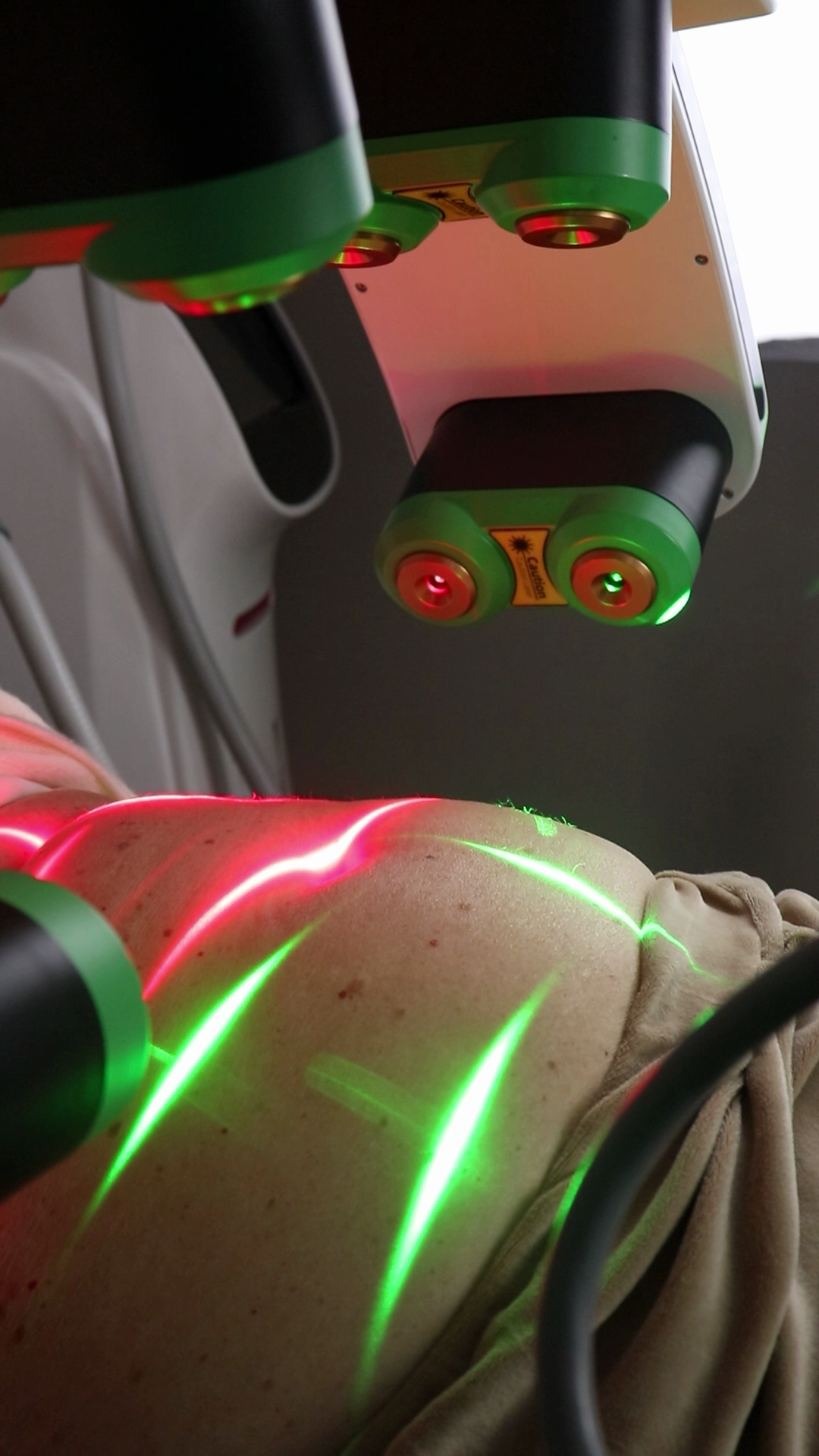 Lipo Max 10D Laser behandling